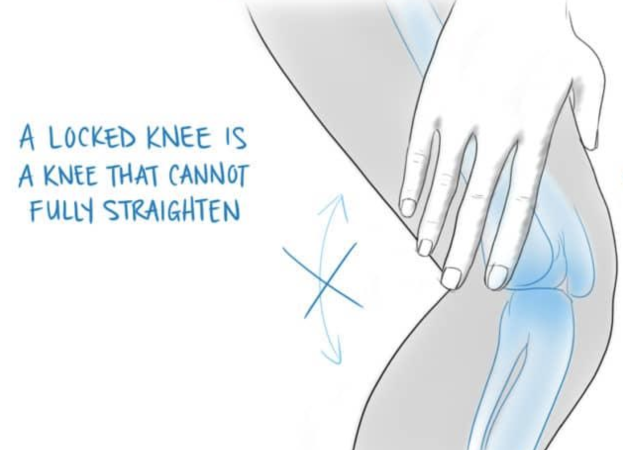 Why Your Knee Locks or Gets Stuck