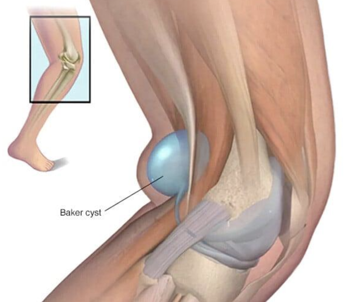 What Is a Baker’s Cyst And Why Does Your Knee Feel Tight Behind It?