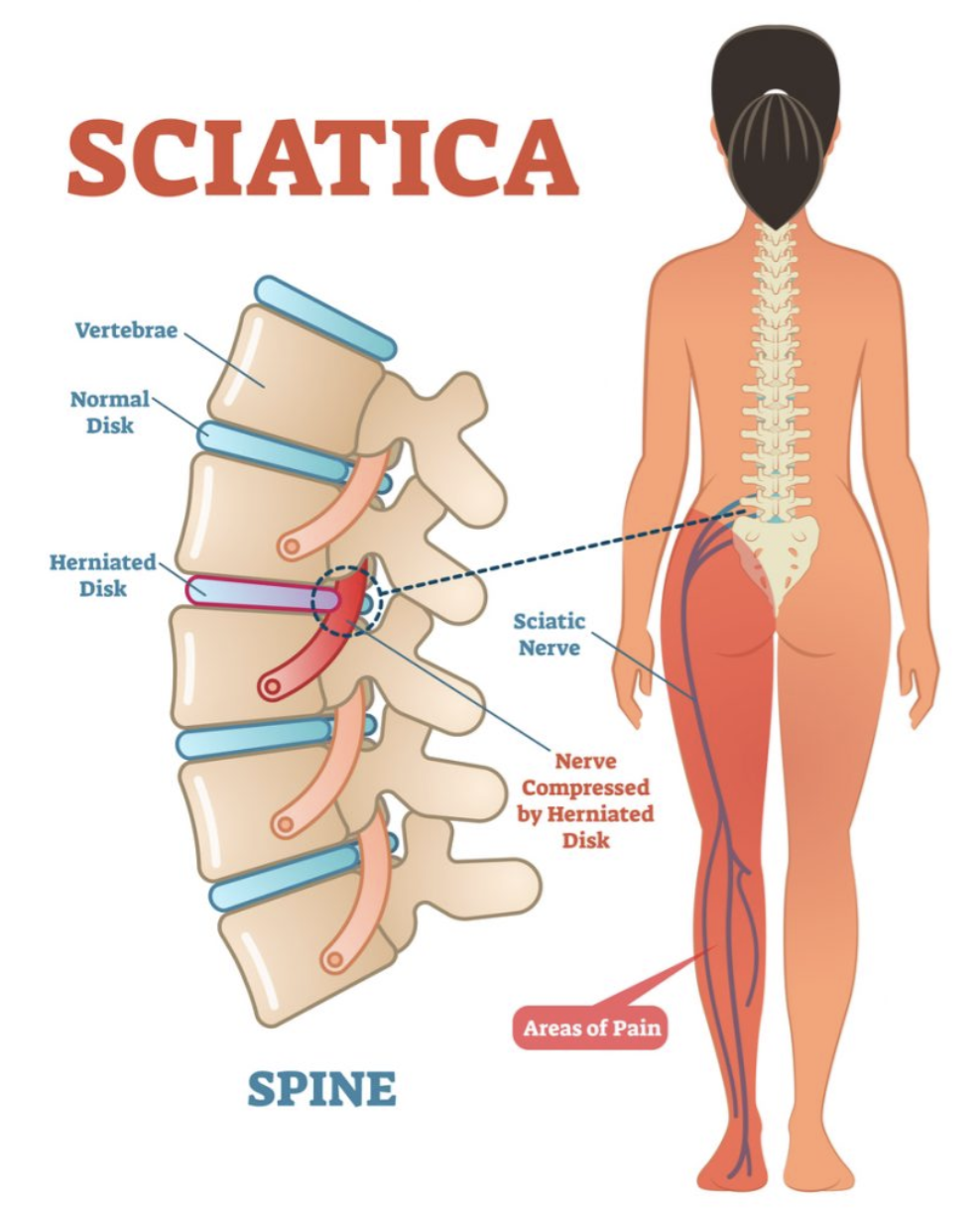 Why Your Leg Feels Weak From Back or Hip Pain