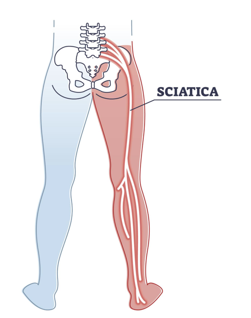 Why Your Foot Feels Numb With Sciatica