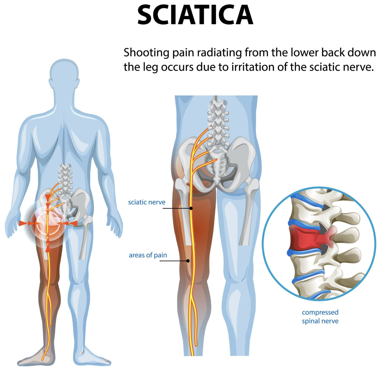 What Causes Burning Pain Down the Leg?
