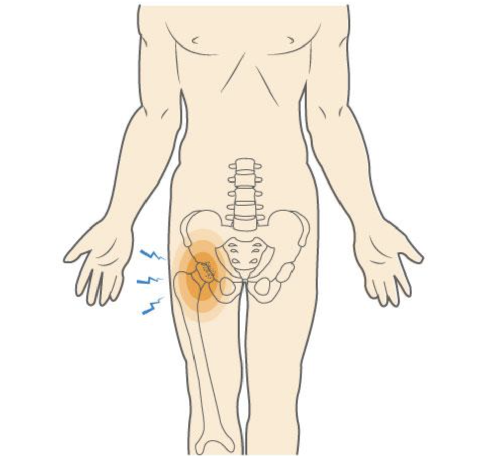 Why Does Hip Pain Travel Down the Thigh?