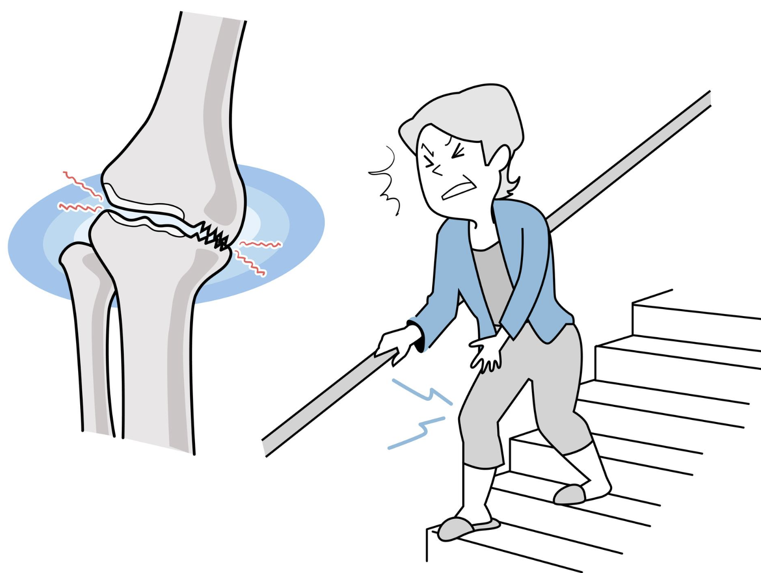 Why Going Down Stairs Hurts Your Knees More Than Going Up