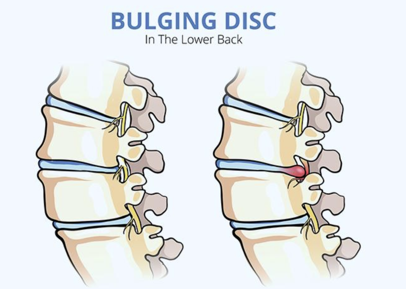 Why a Bulging Disc Doesn’t Always Mean Something Is Seriously Wrong