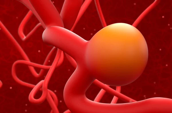 Аневризми артерій