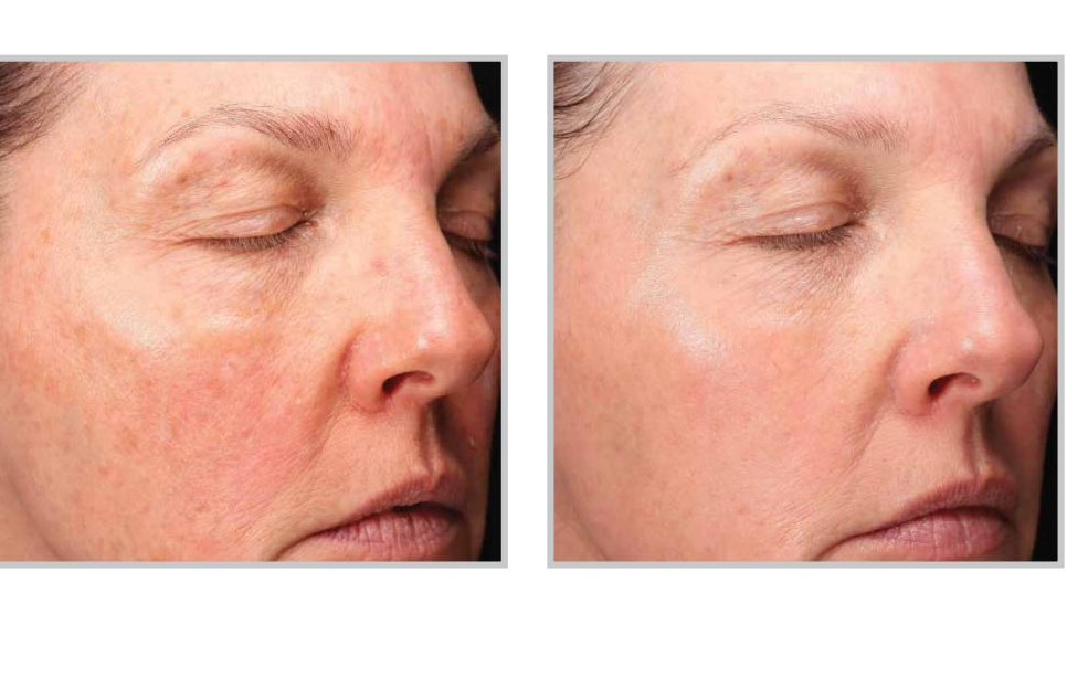 Halo Tribrid Before and After - Glo Skin Spa Midland MI
