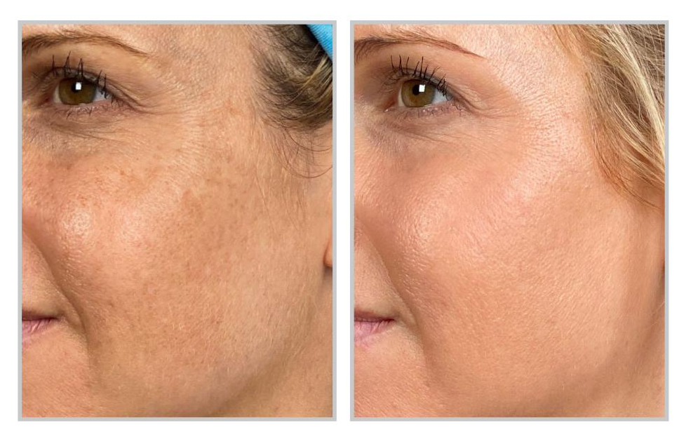 Halo Laser Before and After - Glo Skin Spa Midland MI
