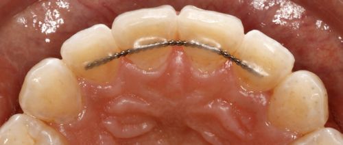 Orthodontic Retainers at Life Orthodontics