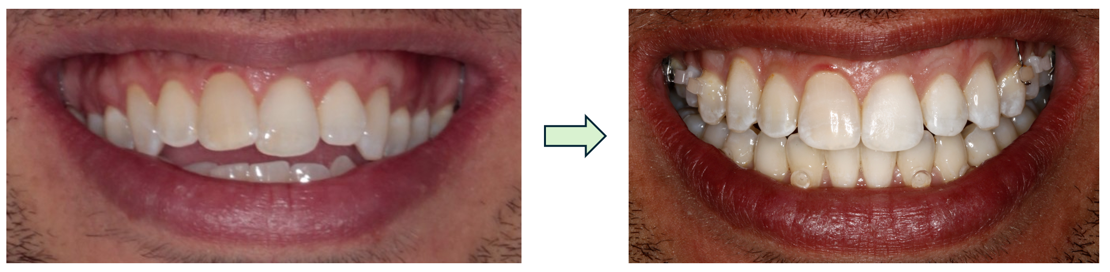 Gummy Smile Treatment at Life Orthodontics