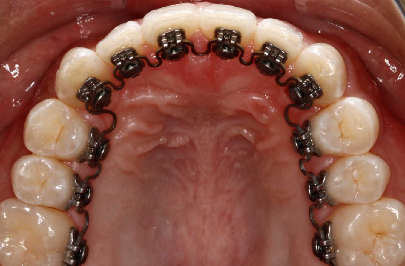 Lingual Braces Life Orthodontics
