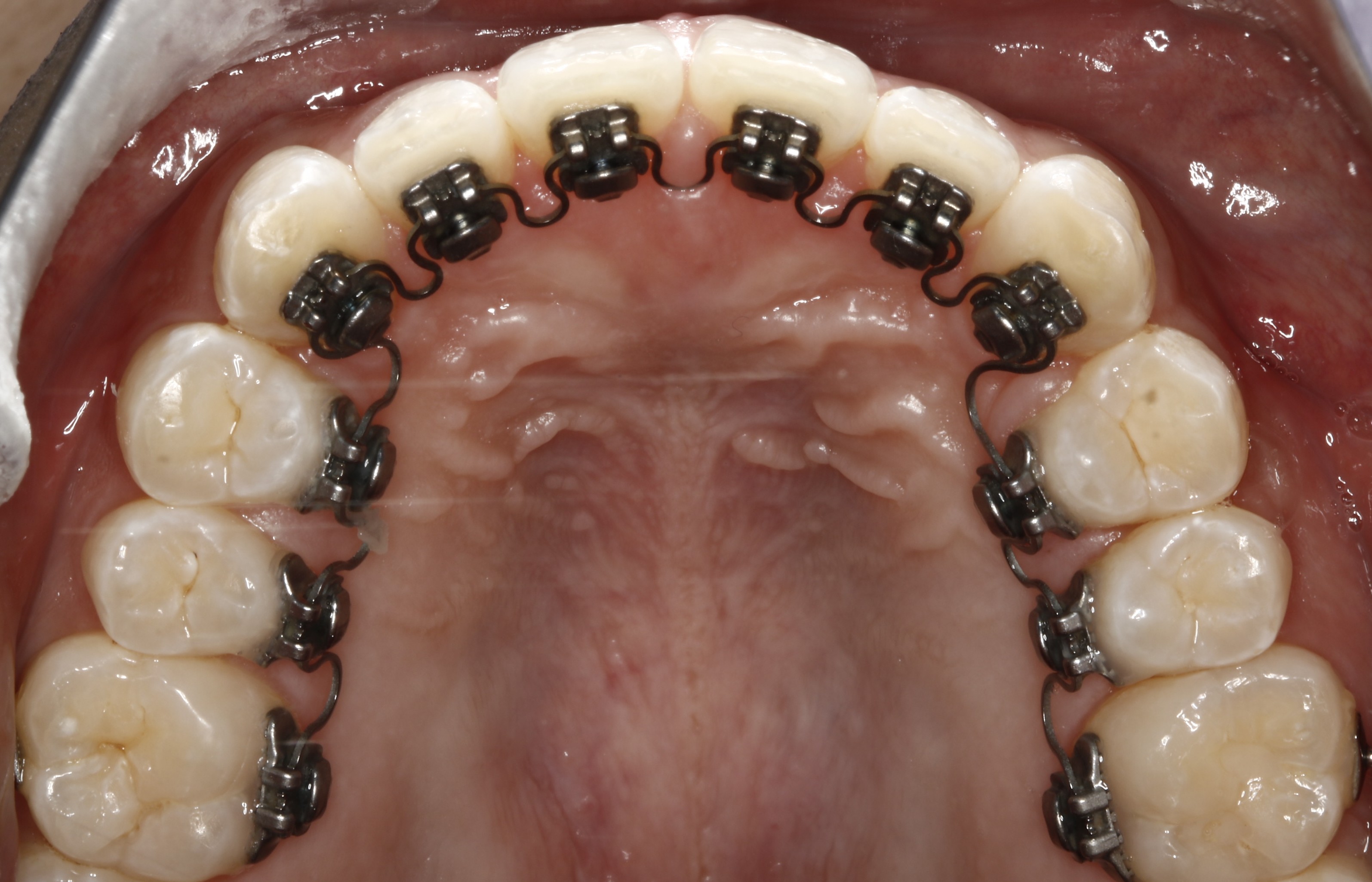 klowen braces columbus Orthodontics Unveils Revolutionary Custom Metal SL Solution Getting Braces: What It Feels