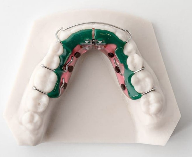 Schwarz Expander at Life Orthodontics