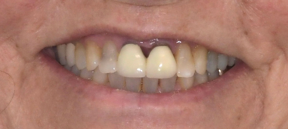 Before photo of discolored teeth with uneven front tooth implants separating from the gums