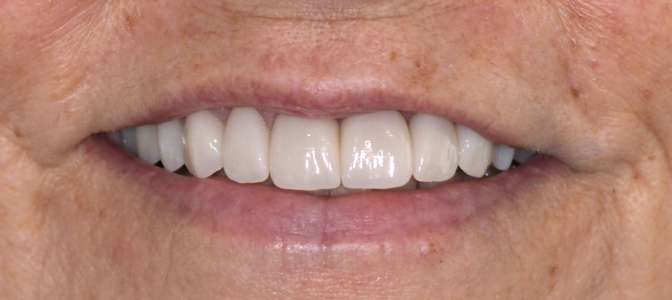 After photo of a smile with even white implants