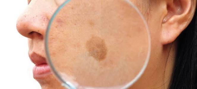 Por que o melasma sempre volta? Entenda a causa real