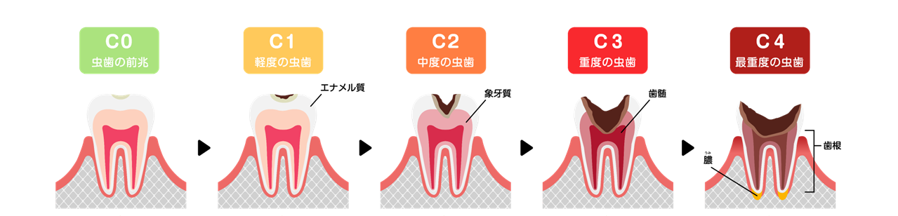 むし歯の進行を表すイラスト