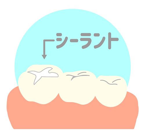 シーラントの説明イラスト