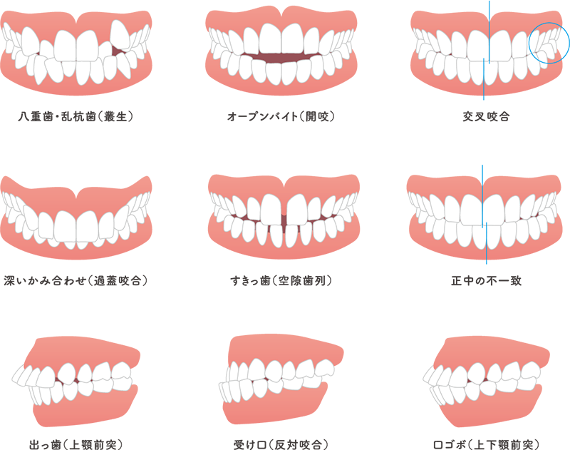不正咬合の種類イラスト
