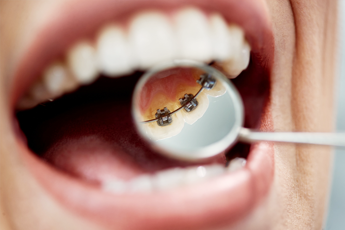 裏側矯正の写真