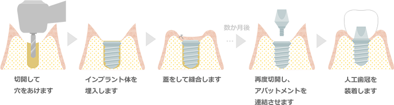 インプラント手術、2回法の治療の流れイラスト