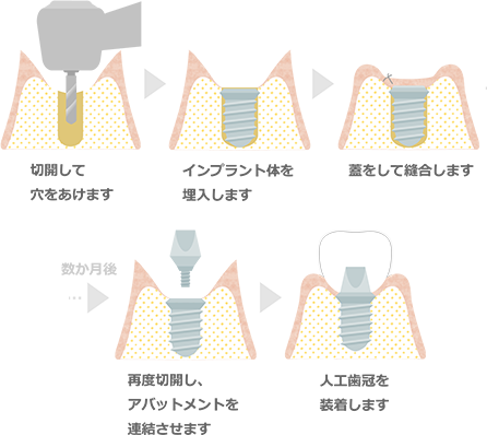 インプラント手術、2回法の治療の流れイラスト