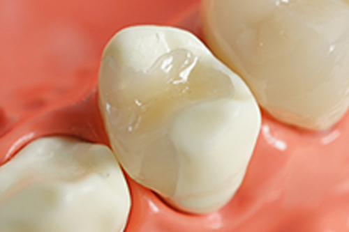 インレーの写真