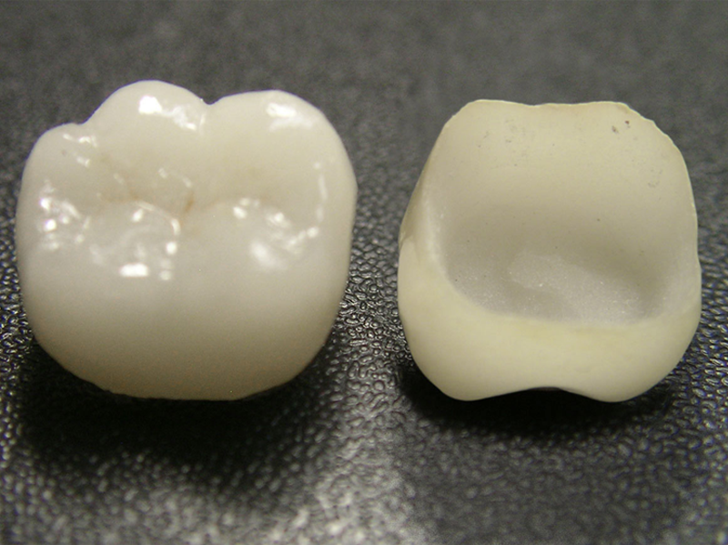 ジルコニア素材の被せものの写真