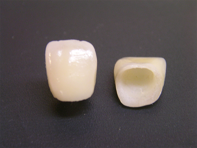 オールセラミック素材の被せものの写真