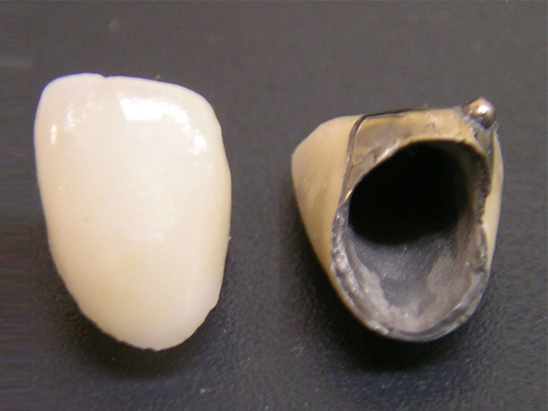 メタルボンド素材の被せものの写真