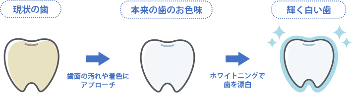 ホワイトニングの流れのイラスト