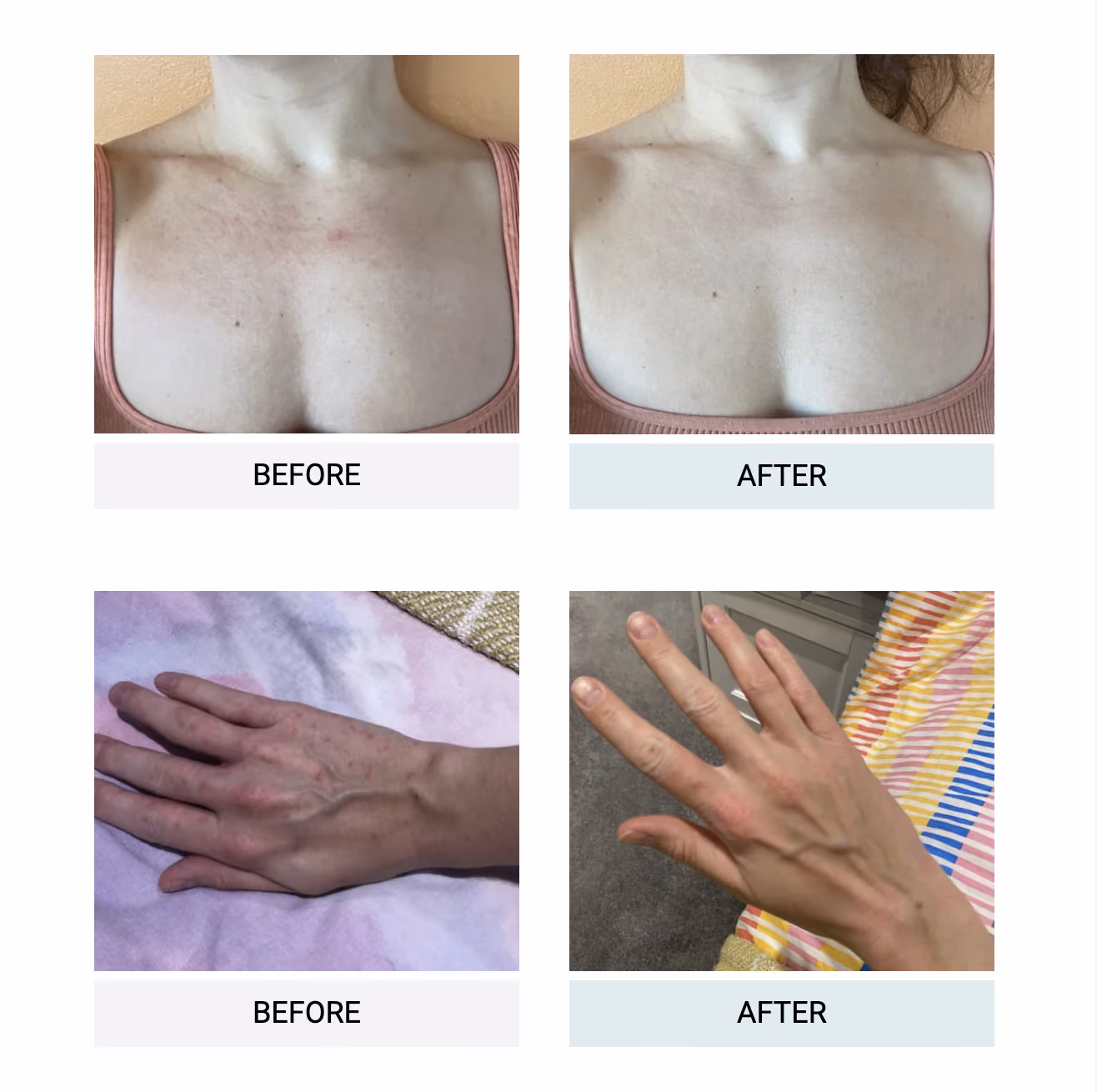 Omnilux Décolleté device