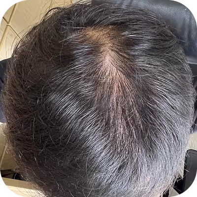 After 6 months of hair loss treatment with Noah™