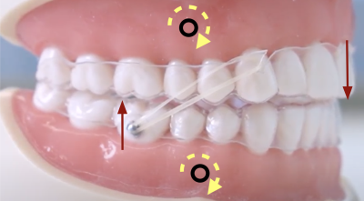 Intermaxillary Elastics With Clear Aligners Types Use