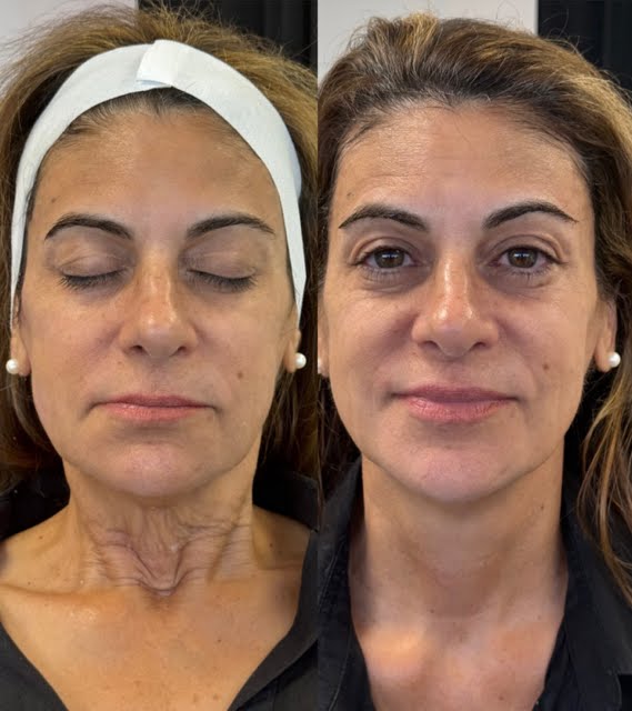 Before XERF, face and neck