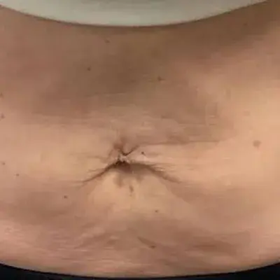 Before XERF, abdomen