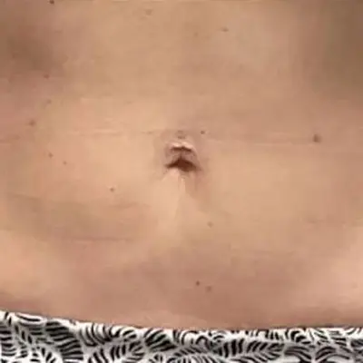 After XERF, abdomen