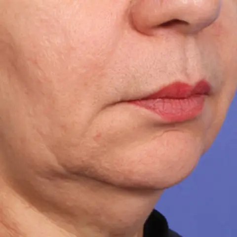 Before XERF, jawline