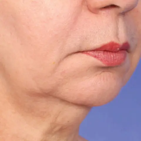 After XERF, jawline