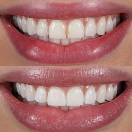 Tooth Whitening : Everything you need to know for a brighter smile