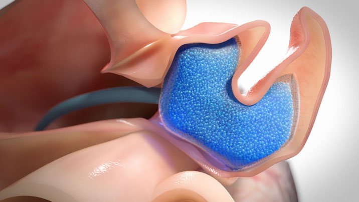 Micro Gel Therapy for Heart Abnormalities - Massachusetts Institute of Technology 
