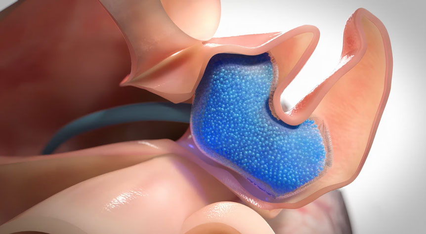 Micro Gel Therapy - MIT - Cardiology Animation