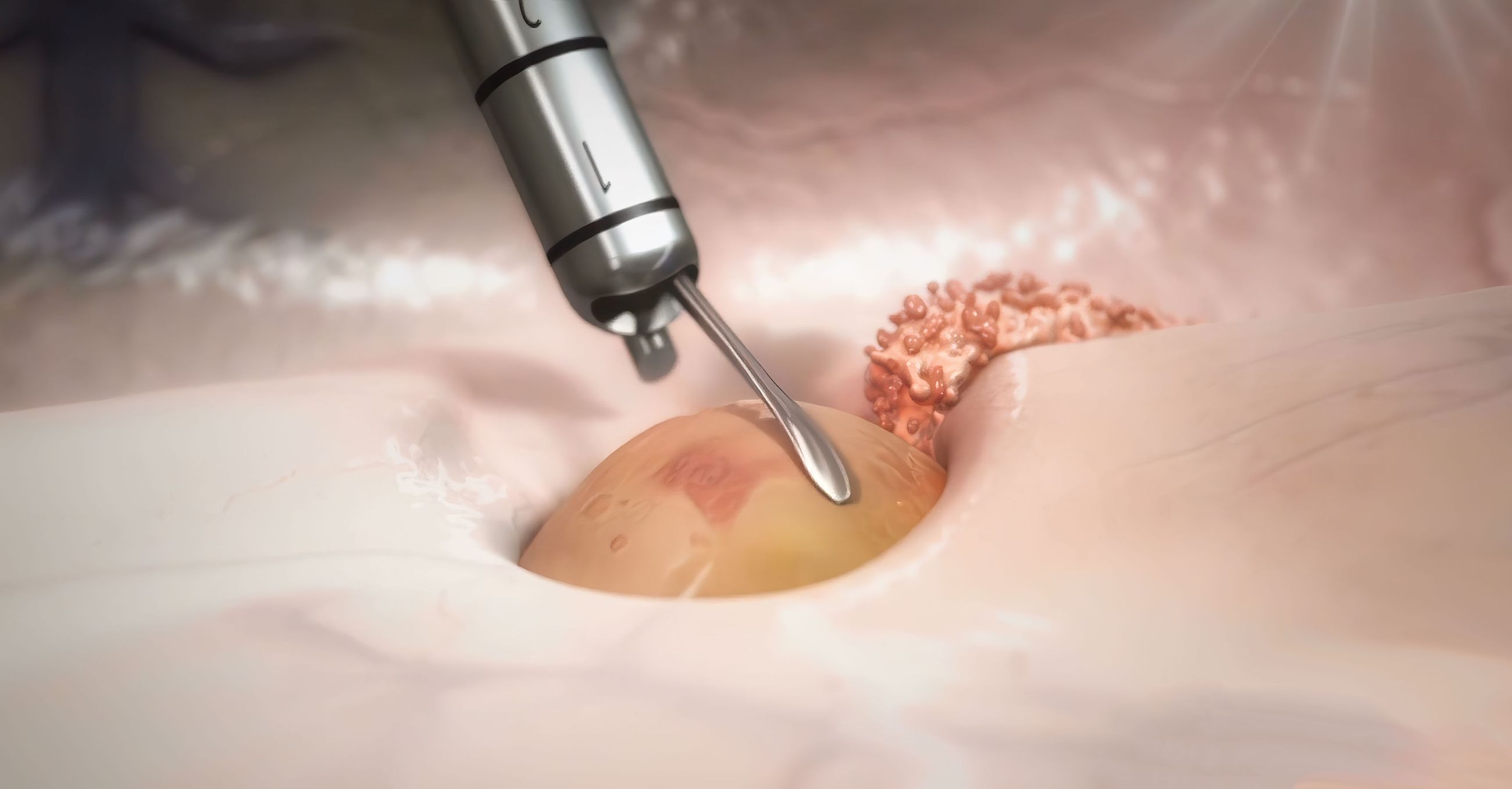 Brain Tumor Resection Illustration - MINOP® InVent | Image