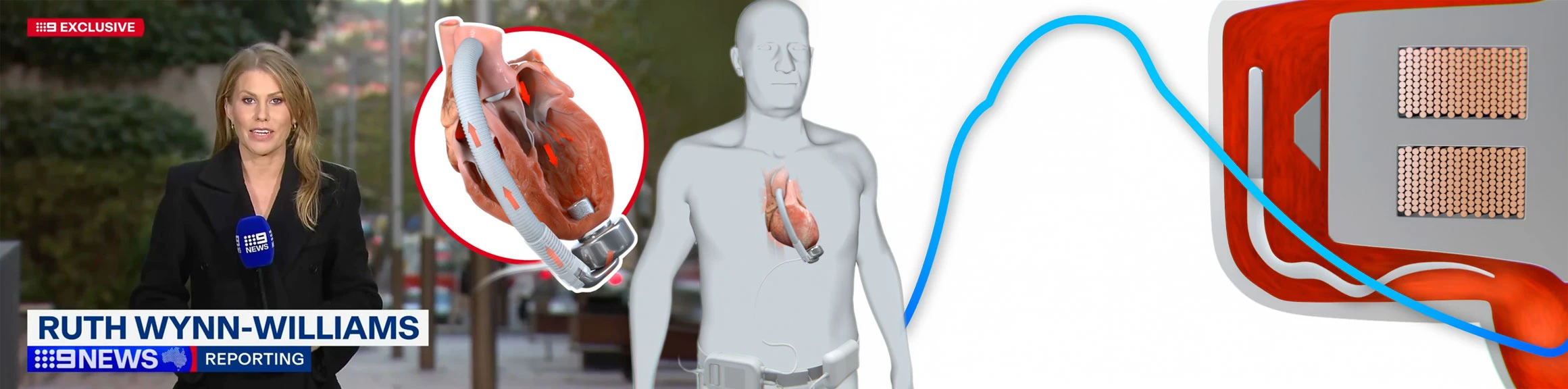 CorWave LVAD ( left-ventricular assist device) visualized and explained through 3D Animation while being discussed on 9News