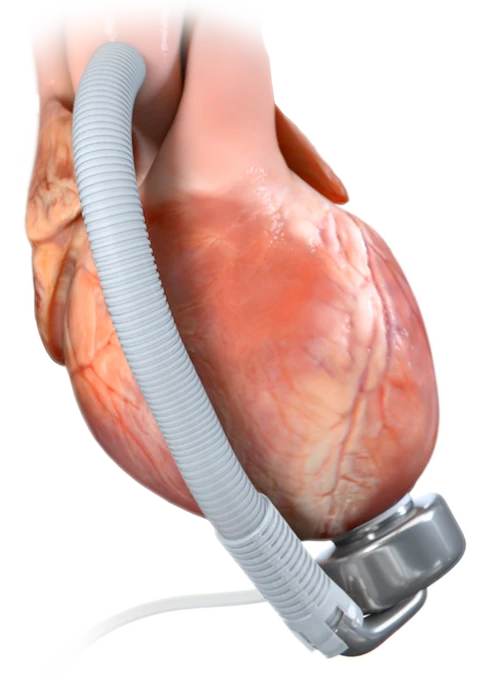 Medical animation of the CorWave LVAD device, which treats advanced heart failure with wave membrane technology. The animation showcases the device's ability to restore blood flow with high fidelity pulsatility, reducing complications and providing a natural treatment option. It recreates the ejection and filling phases of the heart without exposing blood to damage caused by rotary pump LVADs.