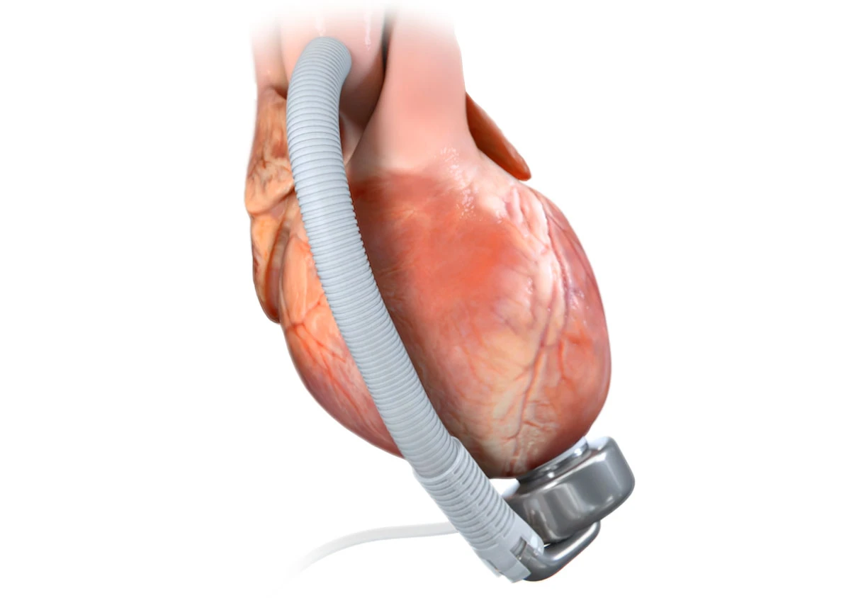 medical animation, Ghost Productions, CorWave LVAD, advanced heart failure, wave membrane technology, blood flow, pulsatility, natural operation, physiological behavior, complications, treatment option, ejection phase, filling phase, rotary pump LVADs, medical device, animation, CorWave, cardiology, heart surgery, heart transplant, cardiovascular disease, heart failure, heart disease, internal medicine, critical care, emergency medicine, surgery, vascular surgery, cardiac surgery, heart specialists, heart surgeons, medical technology.