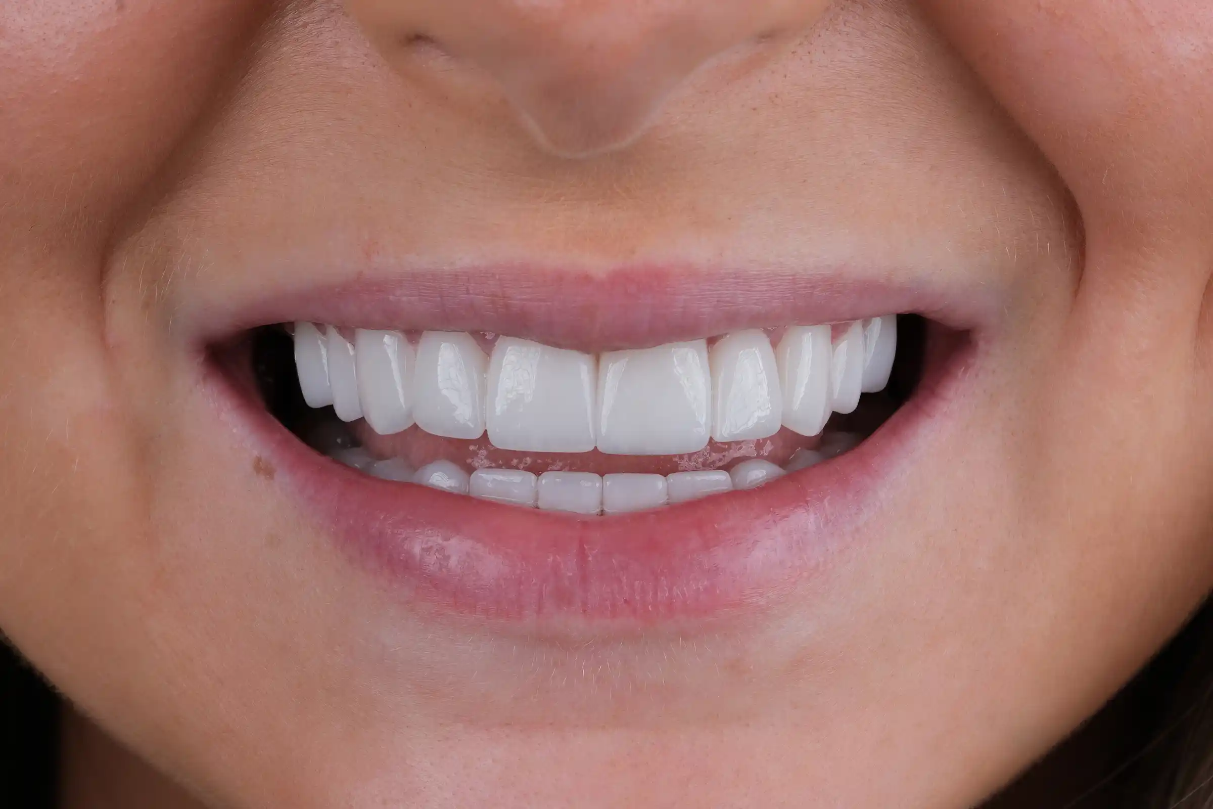 Turkey Teeth Cost: Complete 2026 Price Guide (UK Patients)
