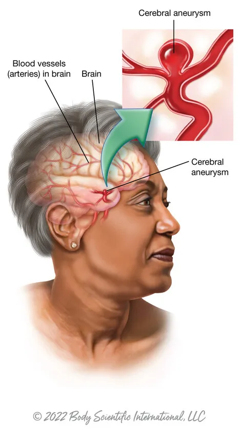 Medical illustration of a black woman with a cerebral aneurysm by Body Scientific.