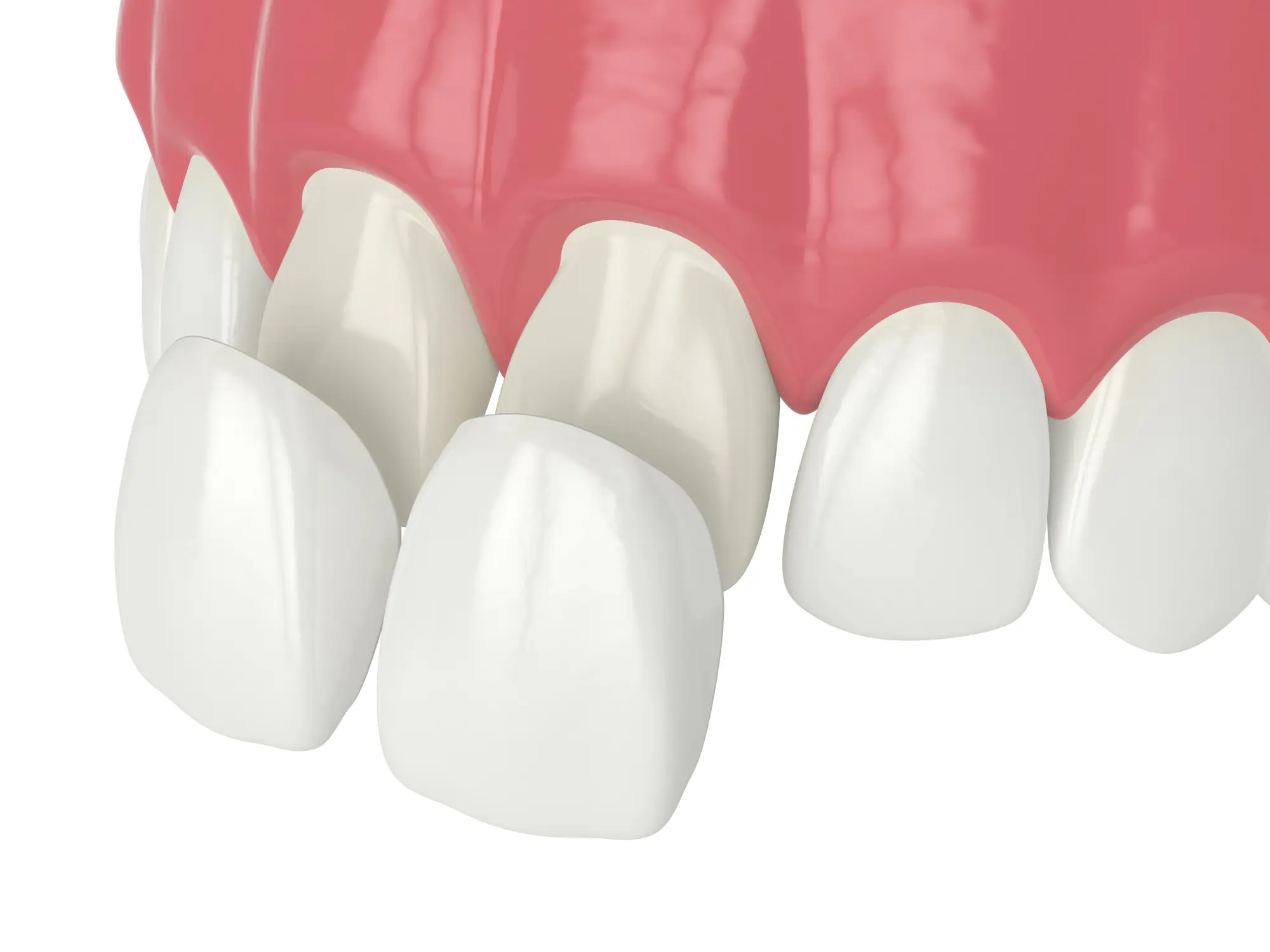 Do You Have to Replace Veneers?