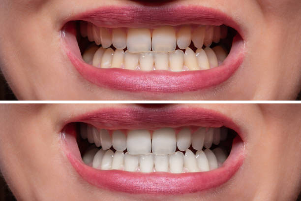 Person Teeth Before And After Whitening Close-up Detail Of Smiling Woman Teeth Before And After Whitening Side-by-side comparison of natural teeth shades before and after whitening stock pictures, royalty-free photos & images