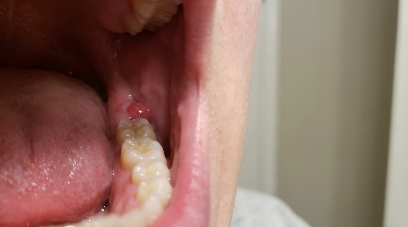 An open mouth shows the tongue, white teeth, pink gums, and a small, red, raised bump on the gum tissue near a back tooth.